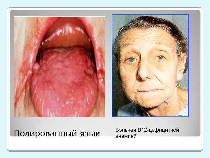 Полированный язык Больная В 12 -дефицитной анемией 