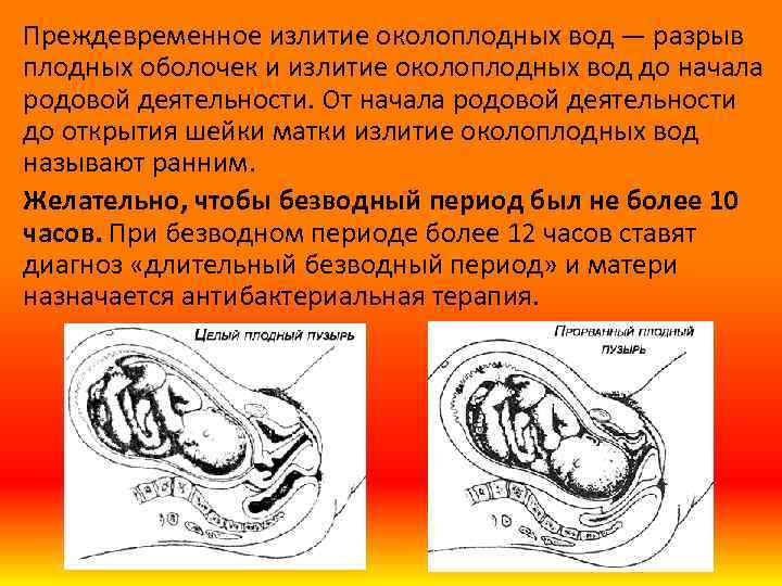 Преждевременное излитие околоплодных вод — разрыв плодных оболочек и излитие околоплодных вод до начала