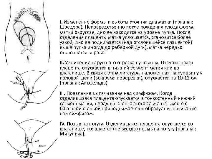 I. Изменение формы и высоты стояния дна матки (признак Шредера). Непосредственно после рождения плода