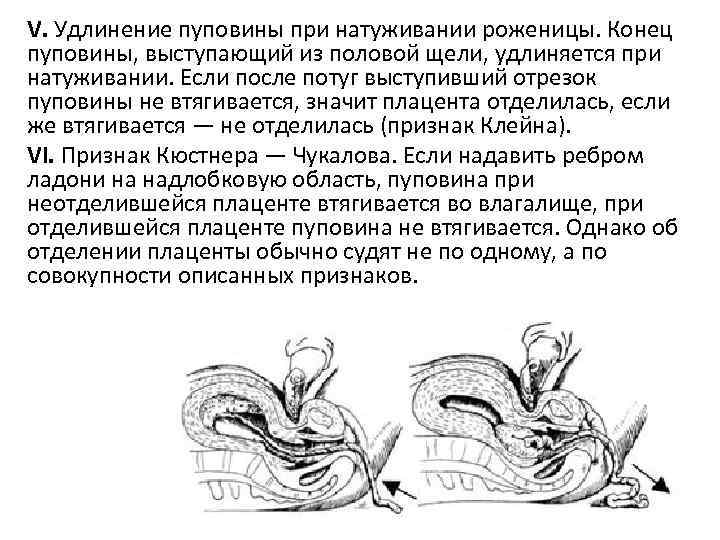 V. Удлинение пуповины при натуживании роженицы. Конец пуповины, выступающий из половой щели, удлиняется при