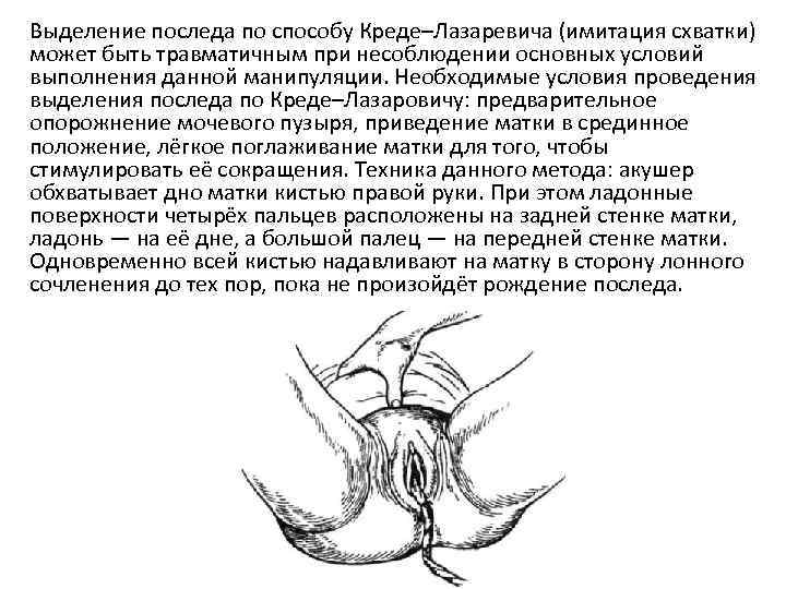 Выделение последа по способу Креде–Лазаревича (имитация схватки) может быть травматичным при несоблюдении основных условий