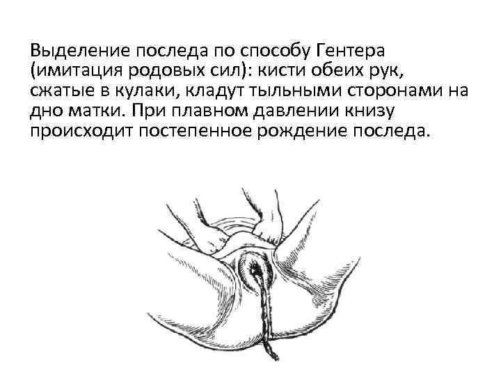 Выделение последа по способу Гентера (имитация родовых сил): кисти обеих рук, сжатые в кулаки,