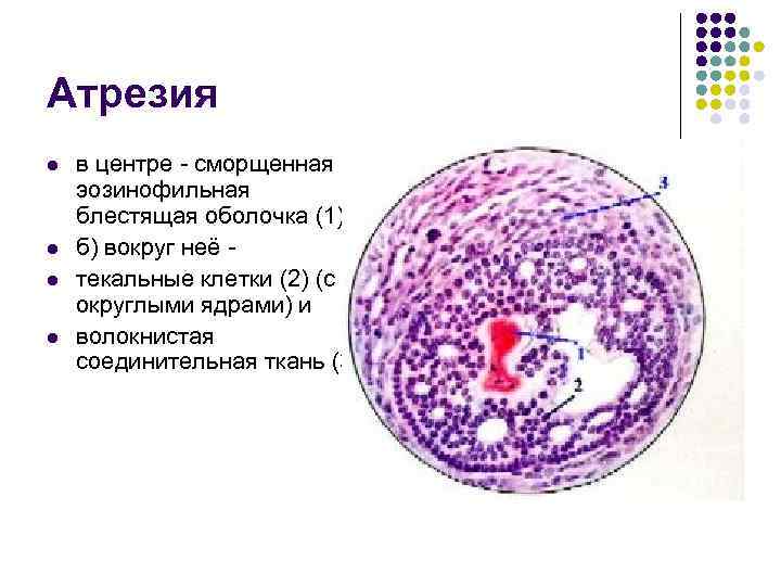 Атрезия l l в центре - сморщенная эозинофильная блестящая оболочка (1), б) вокруг неё