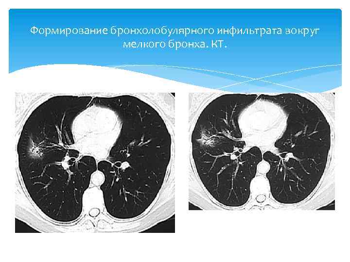 Формирование бронхолобулярного инфильтрата вокруг мелкого бронха. КТ. 