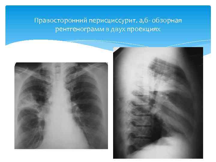 Правосторонний перисциссурит. а, б обзорная рентгенограмм в двух проекциях 