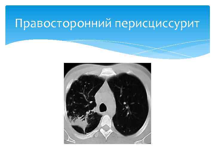 Правосторонний перисциссурит 