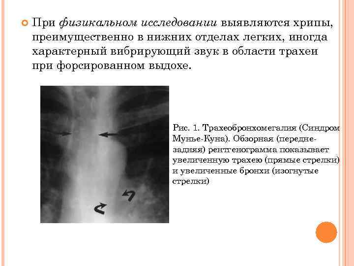  При физикальном исследовании выявляются хрипы, преимущественно в нижних отделах легких, иногда характерный вибрирующий