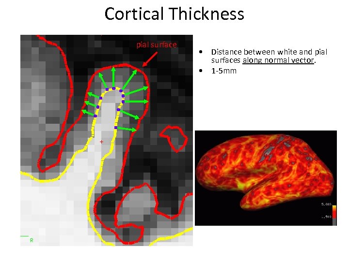 Cortical Thickness pial surface • Distance between white and pial surfaces along normal vector.