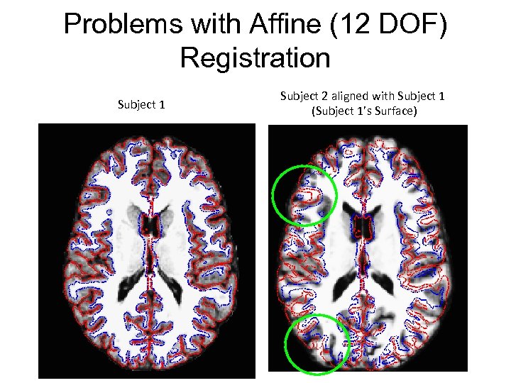 Problems with Affine (12 DOF) Registration Subject 1 Subject 2 aligned with Subject 1