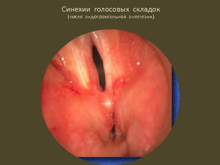 Синехии голосовых складок (после эндотрахеальной анестезии) 