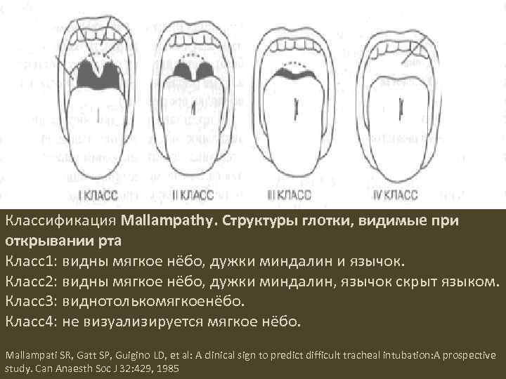 Классификация Mallampathy. Структуры глотки, видимые при открывании рта Класс1: видны мягкое нёбо, дужки миндалин