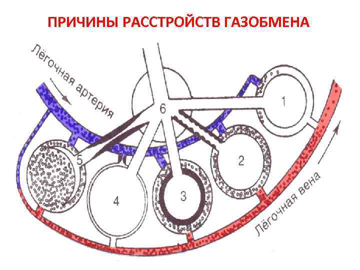 ПРИЧИНЫ РАССТРОЙСТВ ГАЗОБМЕНА 