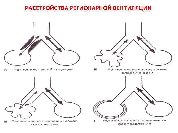 РАССТРОЙСТВА РЕГИОНАРНОЙ ВЕНТИЛЯЦИИ 