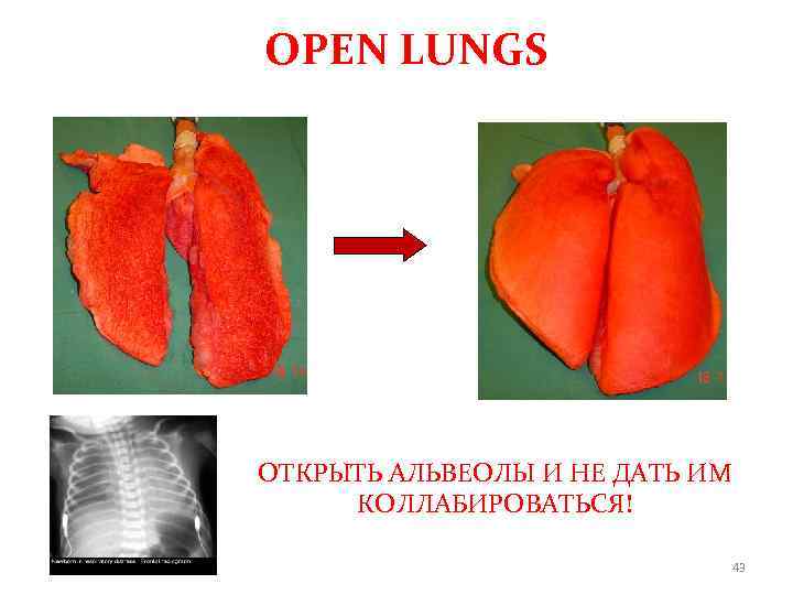 OPEN LUNGS ОТКРЫТЬ АЛЬВЕОЛЫ И НЕ ДАТЬ ИМ КОЛЛАБИРОВАТЬСЯ! 43 