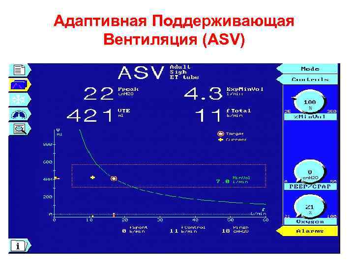 Адаптивная Поддерживающая Вентиляция (ASV) 