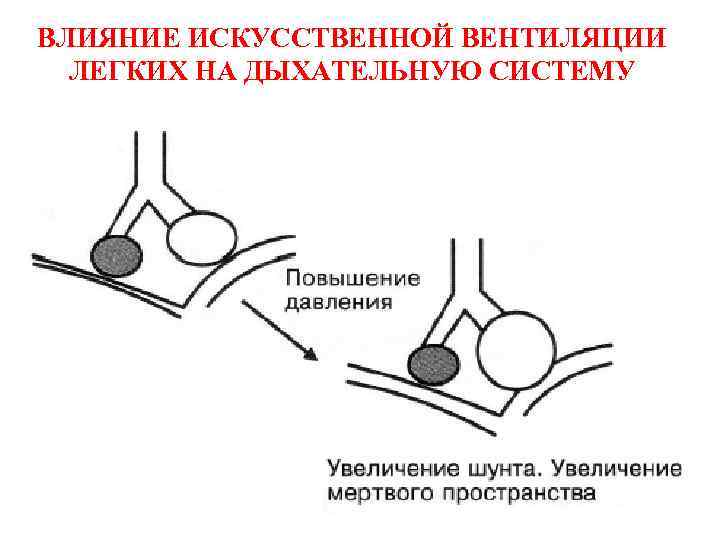 ВЛИЯНИЕ ИСКУССТВЕННОЙ ВЕНТИЛЯЦИИ ЛЕГКИХ НА ДЫХАТЕЛЬНУЮ СИСТЕМУ 