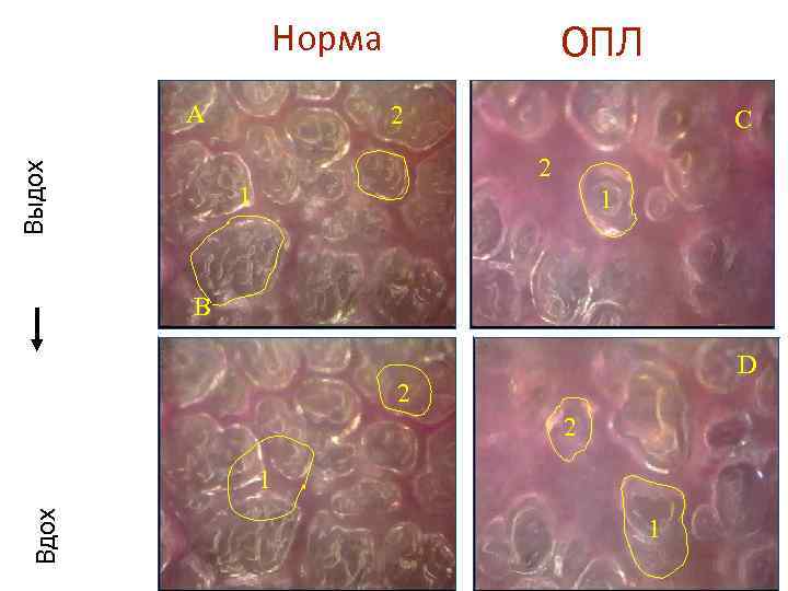 Норма Выдох A ОПЛ 2 C 2 1 1 B D 15 CC/KG 2