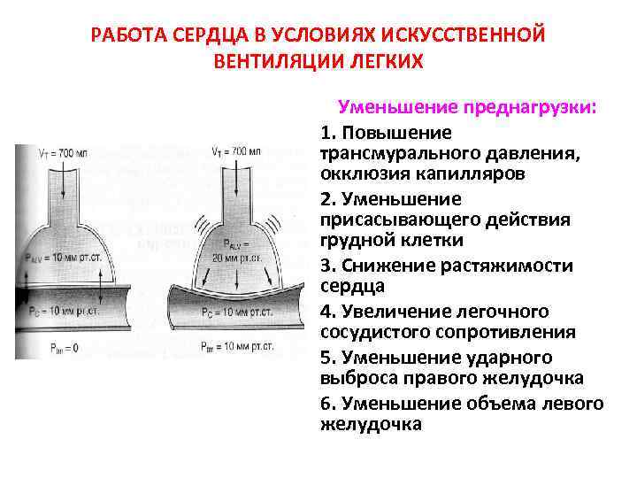 РАБОТА СЕРДЦА В УСЛОВИЯХ ИСКУССТВЕННОЙ ВЕНТИЛЯЦИИ ЛЕГКИХ Уменьшение преднагрузки: 1. Повышение трансмурального давления, окклюзия