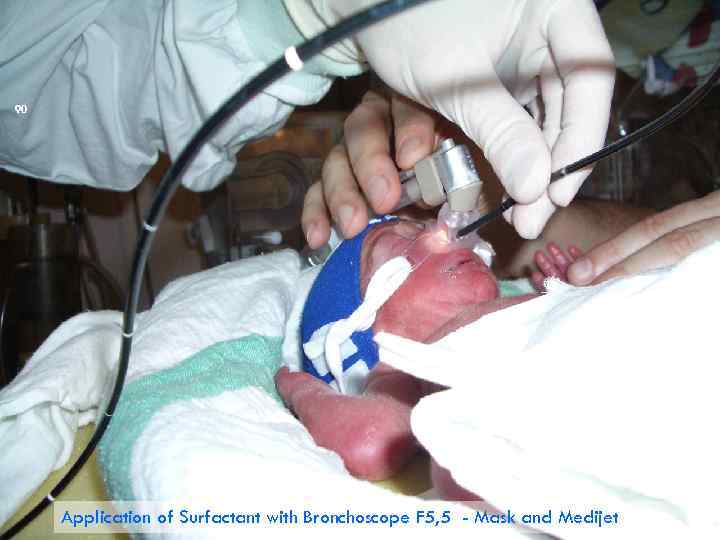 90 Application of Surfactant with Bronchoscope F 5, 5 - Mask and Medijet 