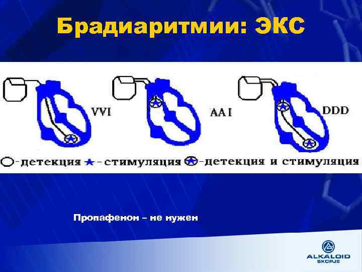 Брадиаритмии: ЭКС Пропафенон – не нужен 