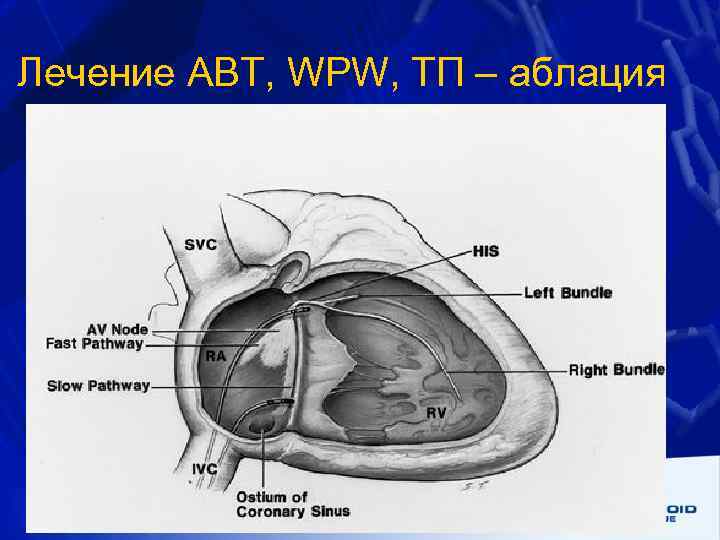 Лечение АВТ, WPW, ТП – аблация 