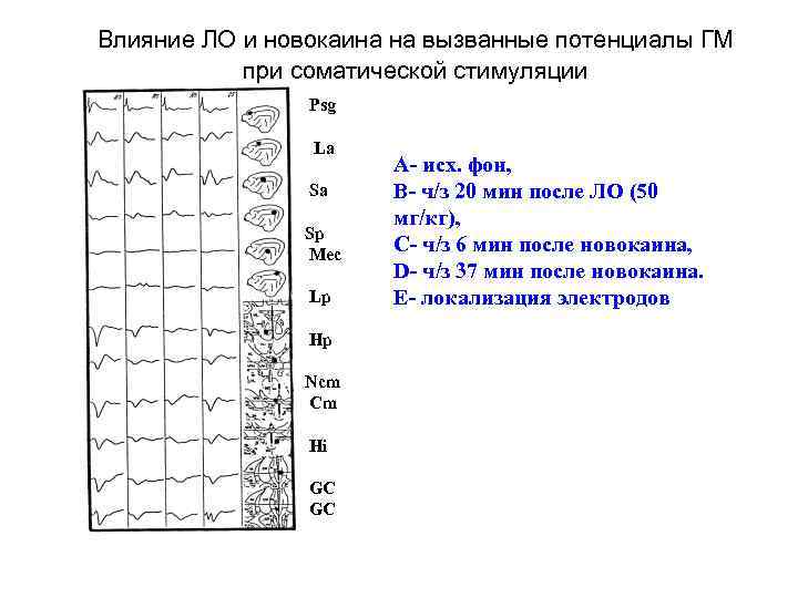 Влияние ЛО и новокаина на вызванные потенциалы ГМ при соматической стимуляции Psg La Sa