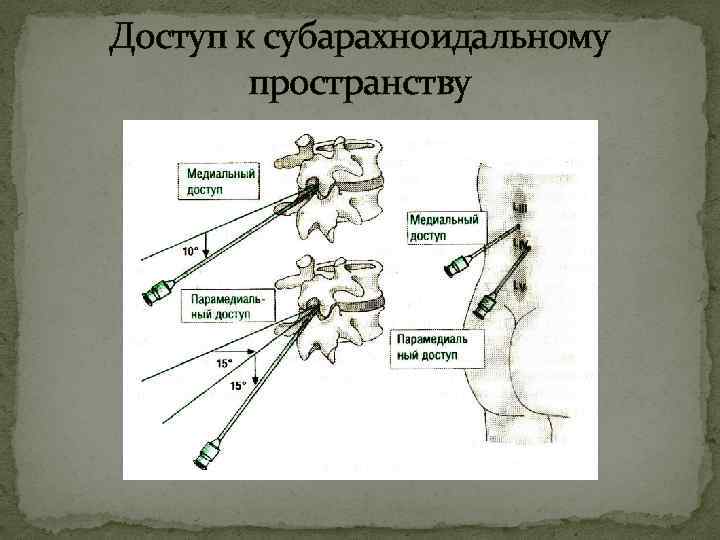 Доступ к субарахноидальному пространству 