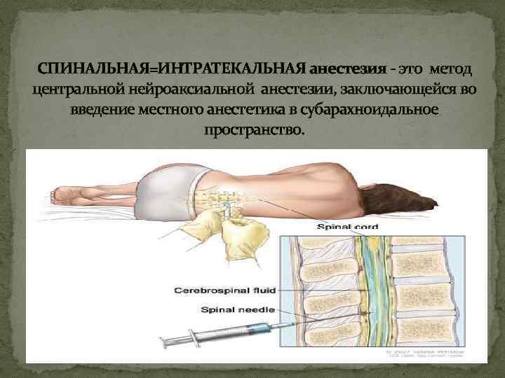 СПИНАЛЬНАЯ=ИНТРАТЕКАЛЬНАЯ анестезия - это метод центральной нейроаксиальной анестезии, заключающейся во введение местного анестетика в