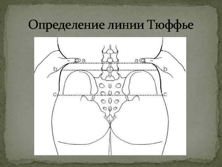 Определение линии Тюффье 