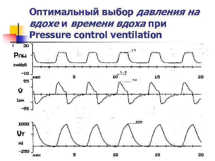 Оптимальный выбор давления на вдохе и времени вдоха при Pressure control ventilation 