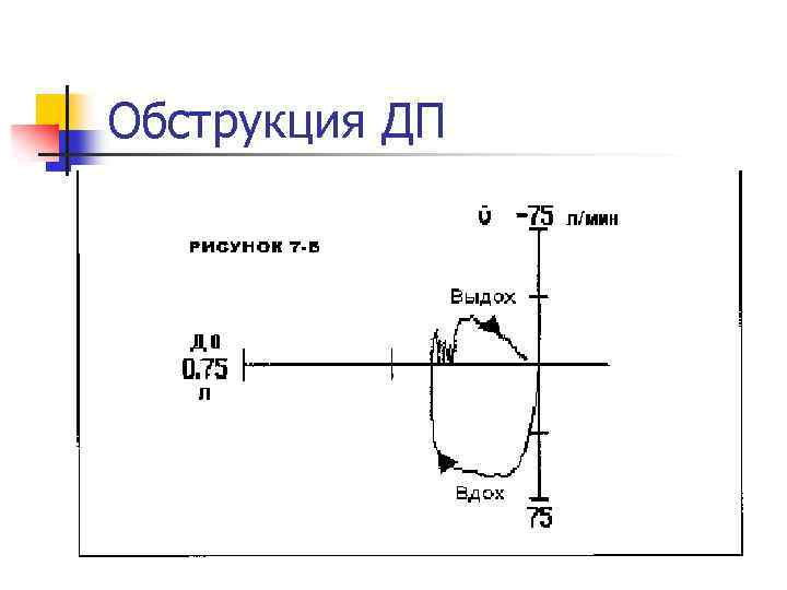 Обструкция ДП 