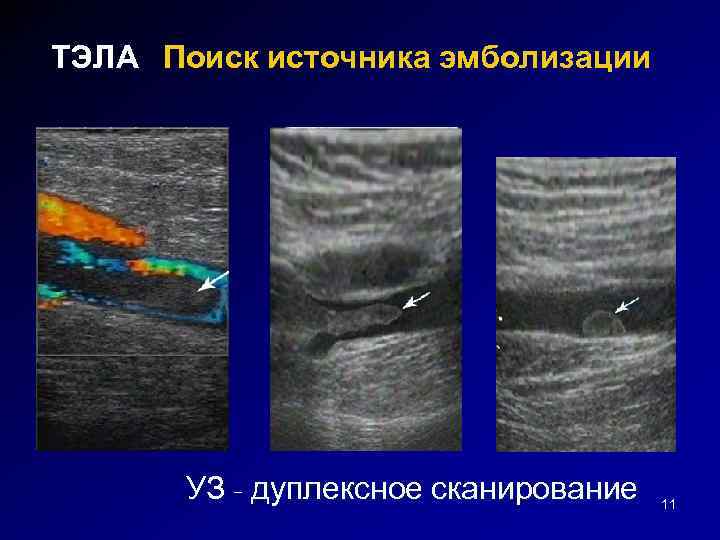 ТЭЛА Поиск источника эмболизации УЗ - дуплексное сканирование 11 