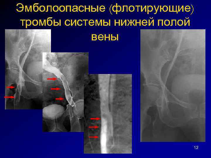 Эмболоопасные (флотирующие) тромбы системы нижней полой вены 12 