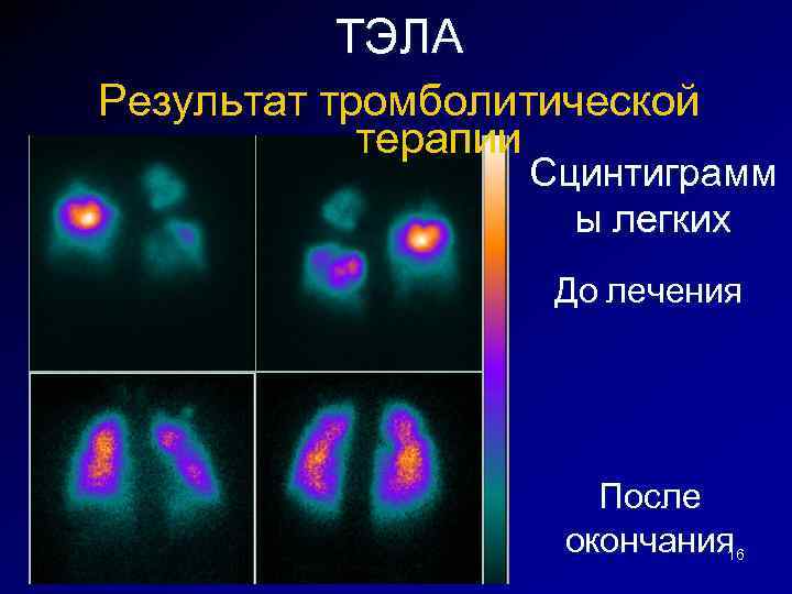 ТЭЛА Результат тромболитической терапии Сцинтиграмм ы легких До лечения После окончания 16 