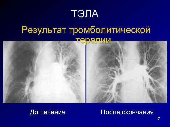 Рецидив тэла. Тромбоэкстракция при Тэла. Восстановление легких после Тэла. Тромбоэмболические осложнения картинки.