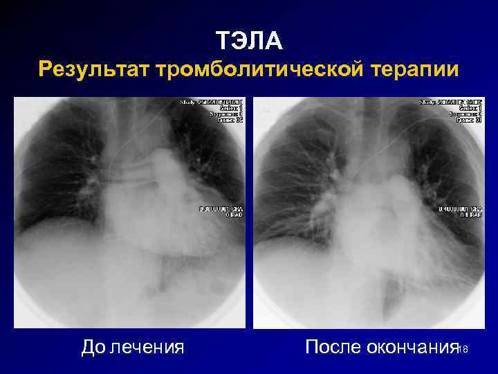 ТЭЛА Результат тромболитической терапии До лечения После окончания 18 