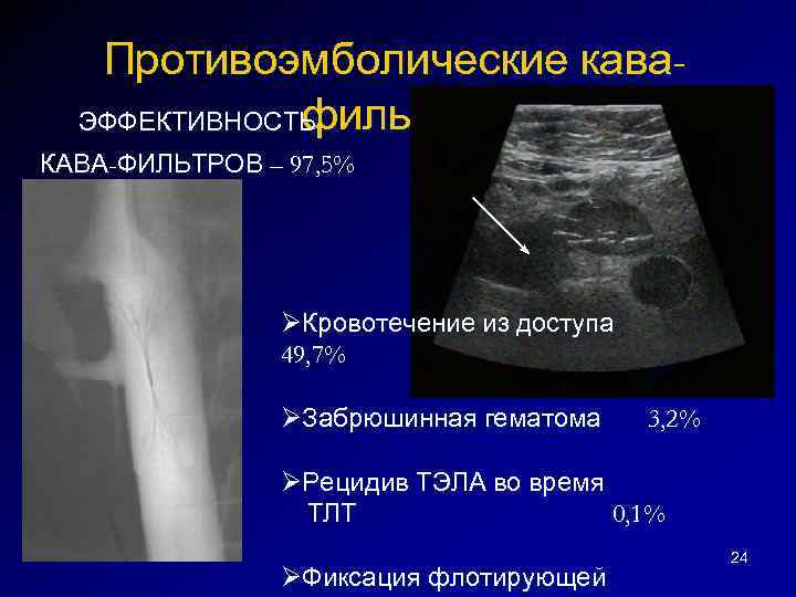 Противоэмболические кавафильтры ЭФФЕКТИВНОСТЬ КАВА-ФИЛЬТРОВ – 97, 5% ØКровотечение из доступа 49, 7% ØЗабрюшинная гематома