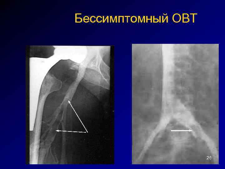 Бессимптомный ОВТ 26 