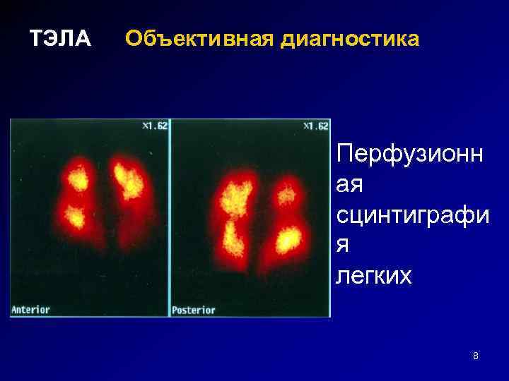 ТЭЛА Объективная диагностика Перфузионн ая сцинтиграфи я легких 8 