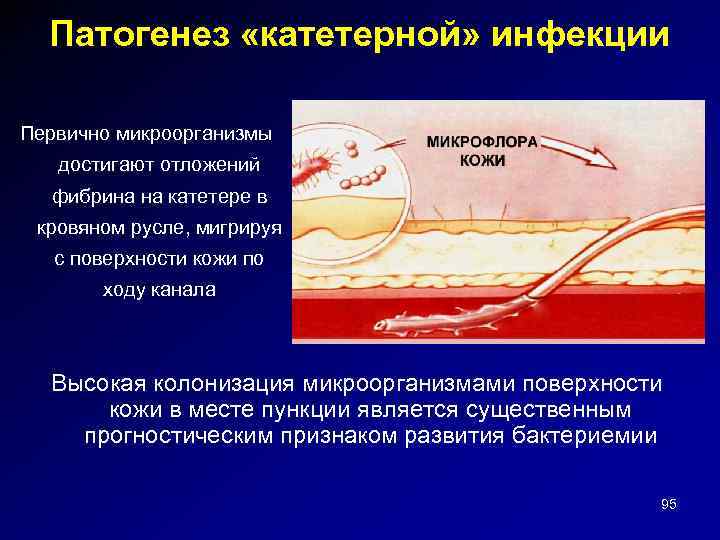 Патогенез «катетерной» инфекции Первично микроорганизмы достигают отложений фибрина на катетере в кровяном русле, мигрируя