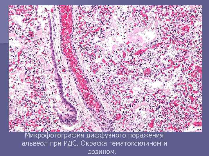 Микрофотография диффузного поражения альвеол при РДС. Окраска гематоксилином и эозином. 