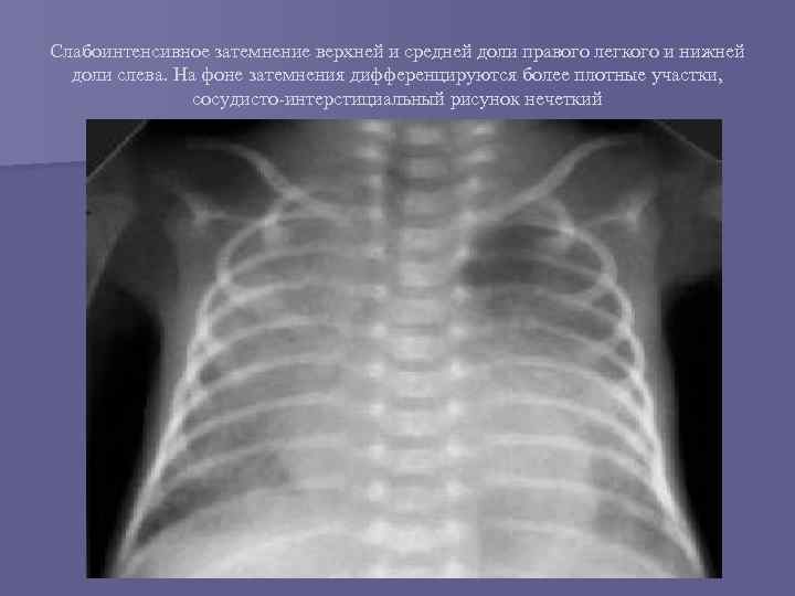 Слабоинтенсивное затемнение верхней и средней доли правого легкого и нижней доли слева. На фоне