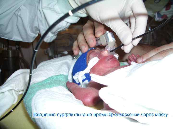 Введение сурфактанта во время бронхоскопии через маску 