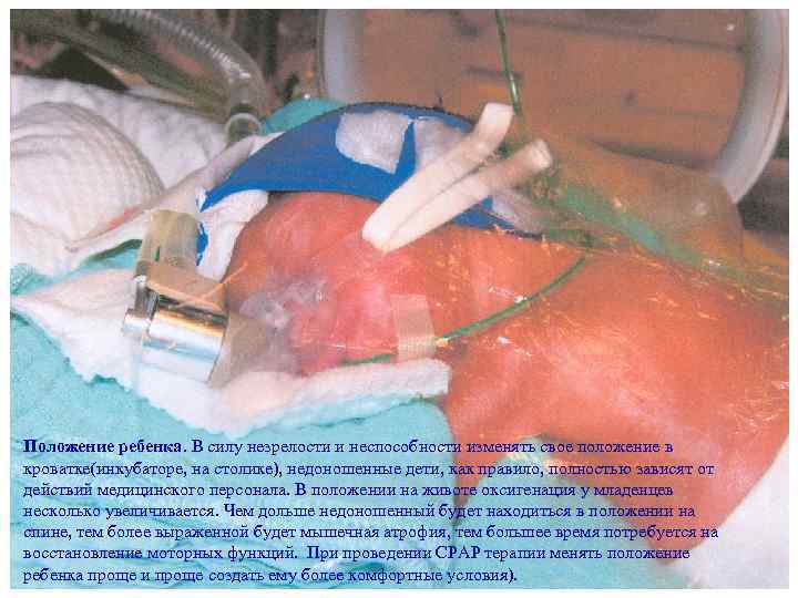 Положение ребенка. В силу незрелости и неспособности изменять свое положение в кроватке(инкубаторе, на столике),