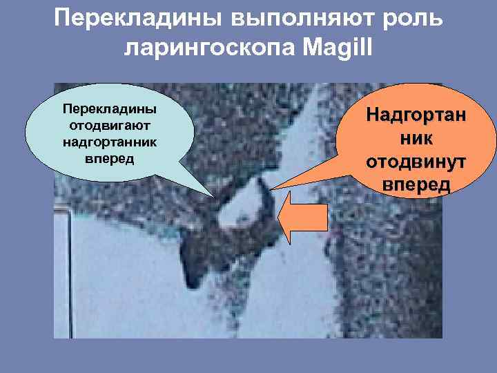 Перекладины выполняют роль ларингоскопа Magill Перекладины отодвигают надгортанник вперед Надгортан ник отодвинут вперед 