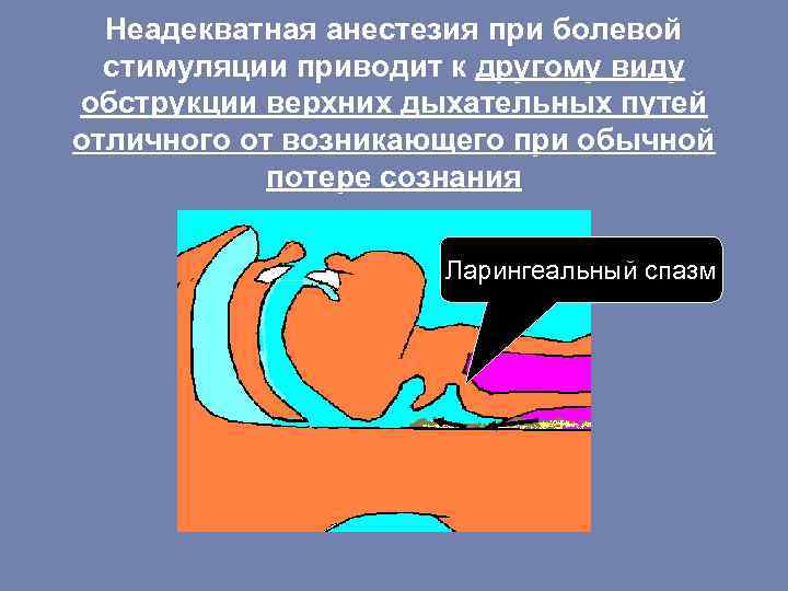 Неадекватная анестезия при болевой стимуляции приводит к другому виду обструкции верхних дыхательных путей отличного