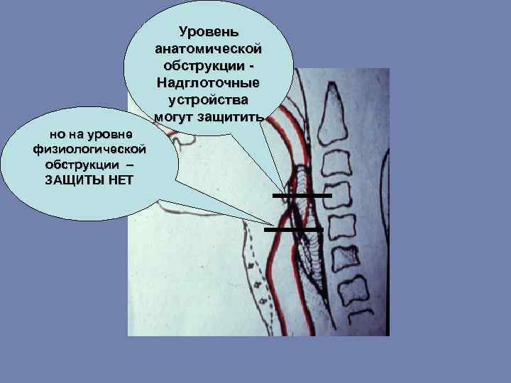 Уровень анатомической обструкции Надглоточные устройства могут защитить но на уровне физиологической обструкции – ЗАЩИТЫ