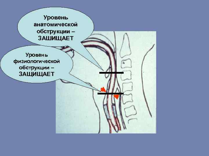 Уровень анатомической обструкции – ЗАШИЩАЕТ Уровень физиологической обструкции – ЗАЩИЩАЕТ 