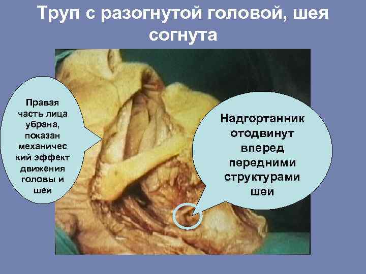 Труп с разогнутой головой, шея согнута Правая часть лица убрана, показан механичес кий эффект