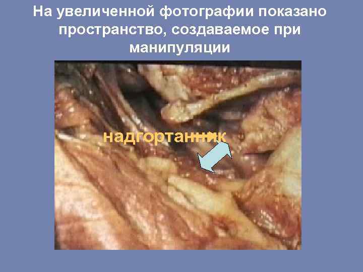 На увеличенной фотографии показано пространство, создаваемое при манипуляции надгортанник 